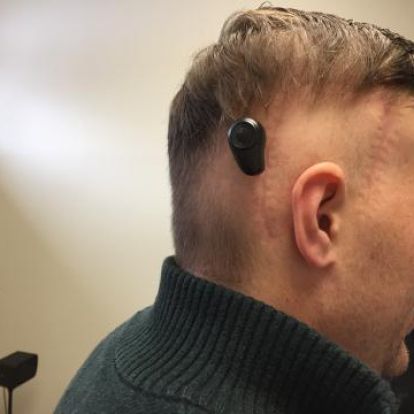 In the BAHA procedure, a titanium implant is surgically placed into the bone behind the ear.  Once the implant has healed in place, a sound processor is attached and activated, providing transmission of sound and significant hearing improvement for the patient.  Kingston's first BAHA recipient, Adam Pennock (pictured here), describes the technology as "very cool."