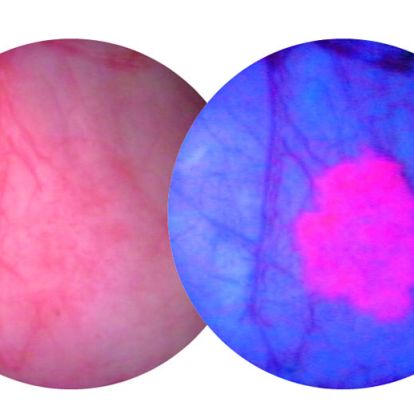 A bladder tumour as seen through a white light scope (L) and a blue light scope (R)